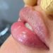 best lip filler in Sydney