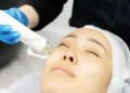 RF Microneedling Benefits