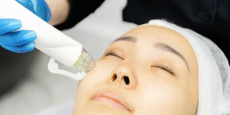 RF Microneedling Benefits