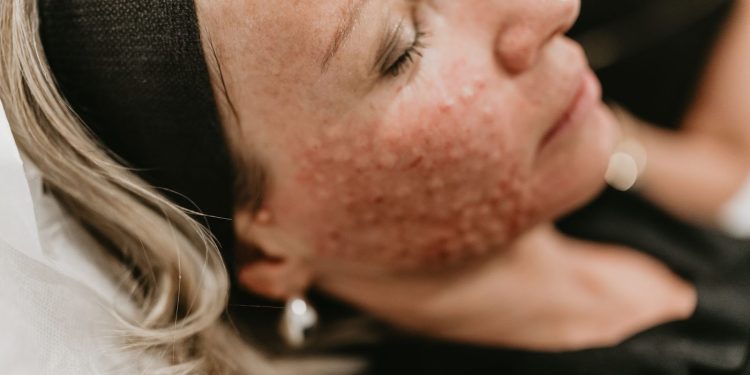 Rejuran skin treatment benefits