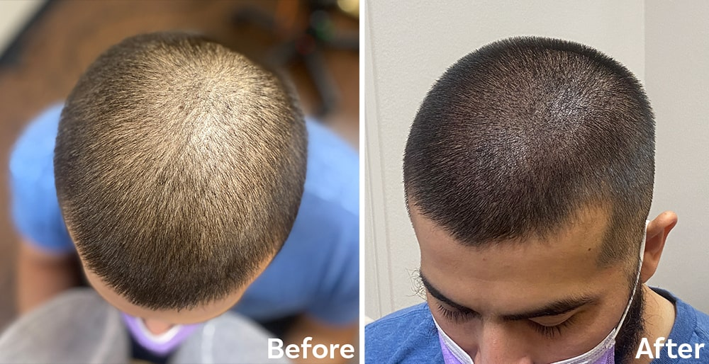 scalp micropigmentation in Sydney